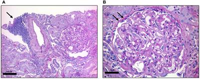 Case Report: Rapid renal response to venetoclax monotherapy in a CLL patient with secondary membranous glomerulonephritis